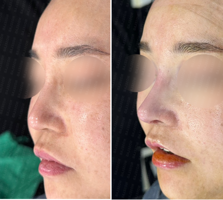 Oblique view before (left) and immediately after (right) nasal septum reconstruction surgery
