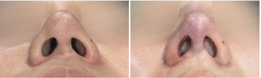 Nostril view before and immediately after closed rhinoplasty Korea following permanent filler removal