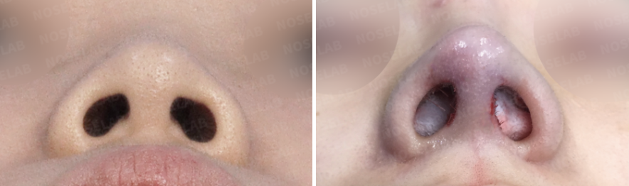 Short nose rhinoplasty – before and after comparison nostril view (left before, right after)