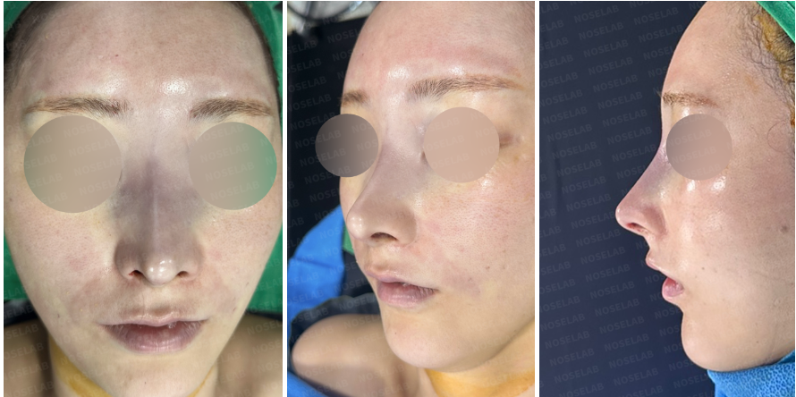 mmediately after surgery: frontal, side, and oblique side view showing nasal shape improvement following closed revision rhinoplasty with rib cartilage graft.