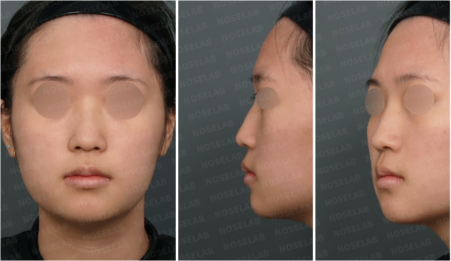 Preoperative design consultation photos showing drooping nasal tip due to small alar cartilages, dorsal hump, and deviated nasal bridge from frontal, left oblique, and left lateral views.