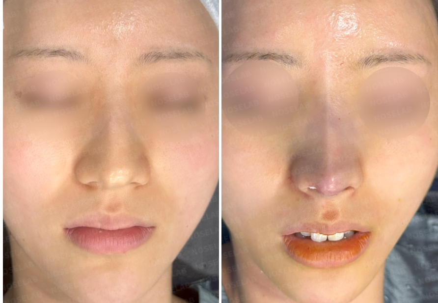 Before and immediately after hump nose correction – frontal view showing dorsal hump removal, tip refinement, and improved nasal bridge alignment.