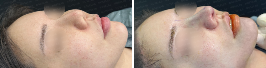 45-degree angle before surgery (left), After surgery (right)