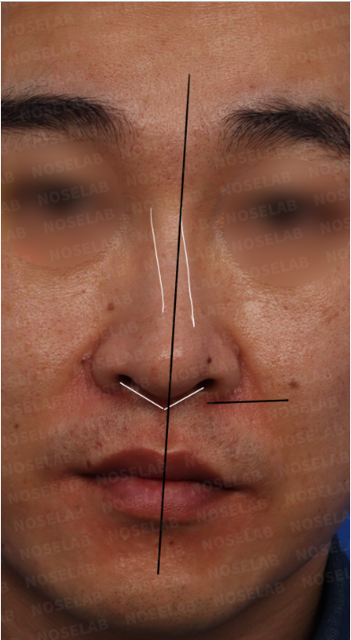Frontal view before arrow nose correction showing long, deviated nose with asymmetry
