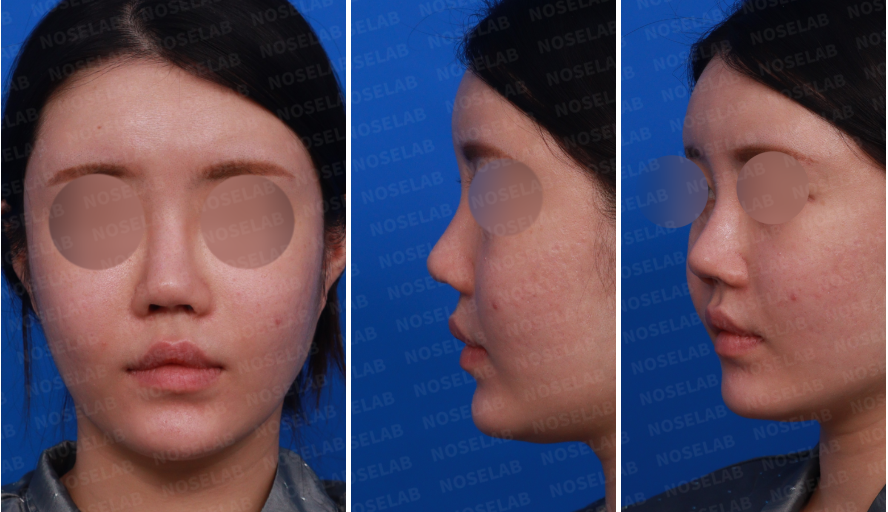 Design consultation image showing the patient’s frontal, left side, and oblique side views before rhinoplasty surgery.