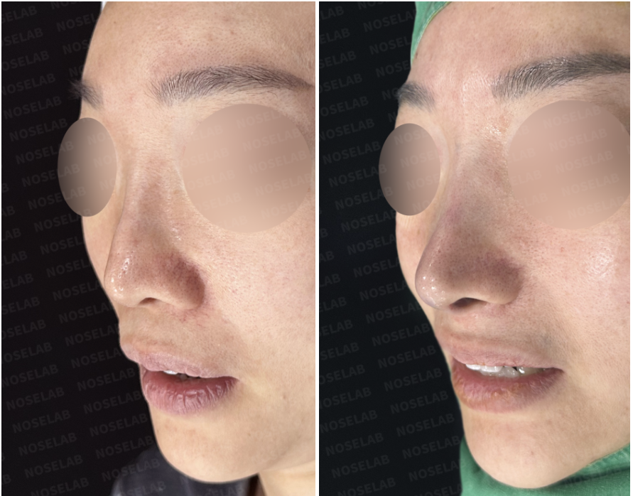 Oblique view before and immediately after autologous rib cartilage revision rhinoplasty