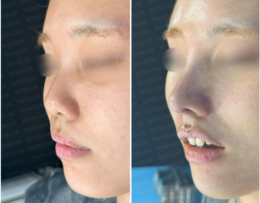 Before and after small blunt nose correction surgery – oblique side view comparison