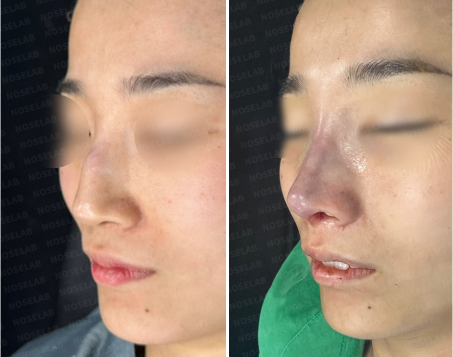 Three-quarter view comparison of closed nasal inflammation revision: Before surgery (left) shows implant-related shadowing and nasal swelling; immediately after surgery (right) shows improved tip projection, reduced inflammation, and natural skin contour.