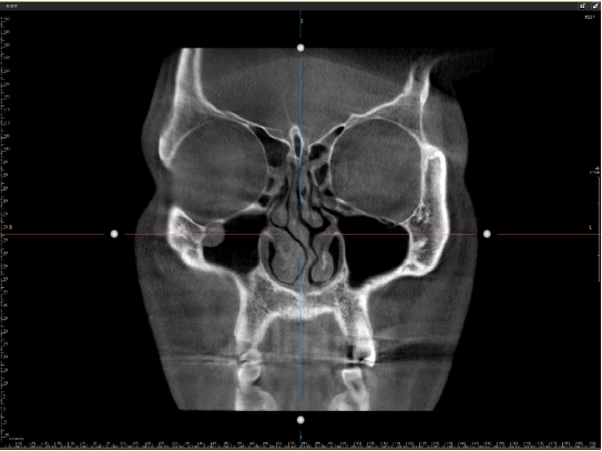 Preoperative CT scan before arrow nose correction showing deviated septum and sinus