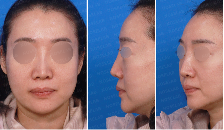 Preoperative views before autologous rib cartilage revision rhinoplasty showing frontal and side profiles