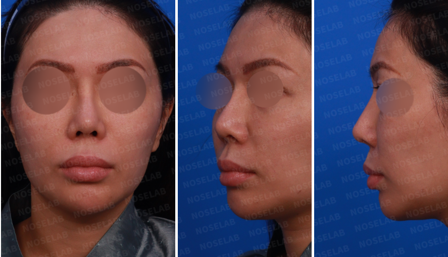 Silitex implant removal rhinoplasty revision – frontal, left side, and oblique side view before surgery