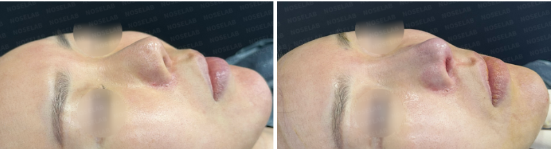 Side profile view before surgery (left) after surgery (right)