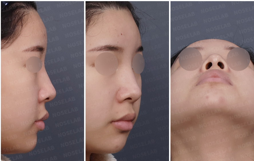 Preoperative design consultation images showing right lateral view, right oblique side view, and nostril view of a patient with a wide nasal bridge and low nasal tip projection.