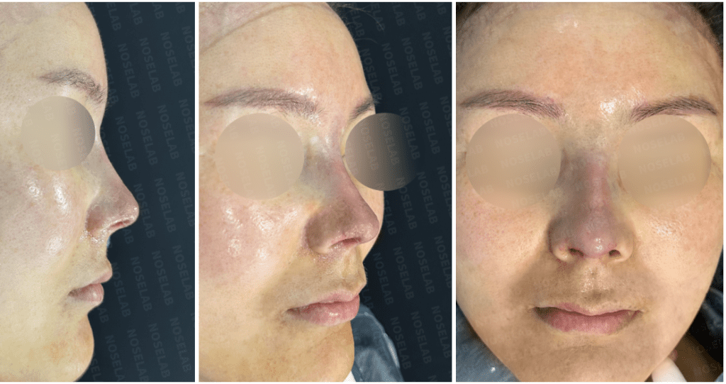 Postoperative side, oblique, and frontal views after nasal tip redness correction