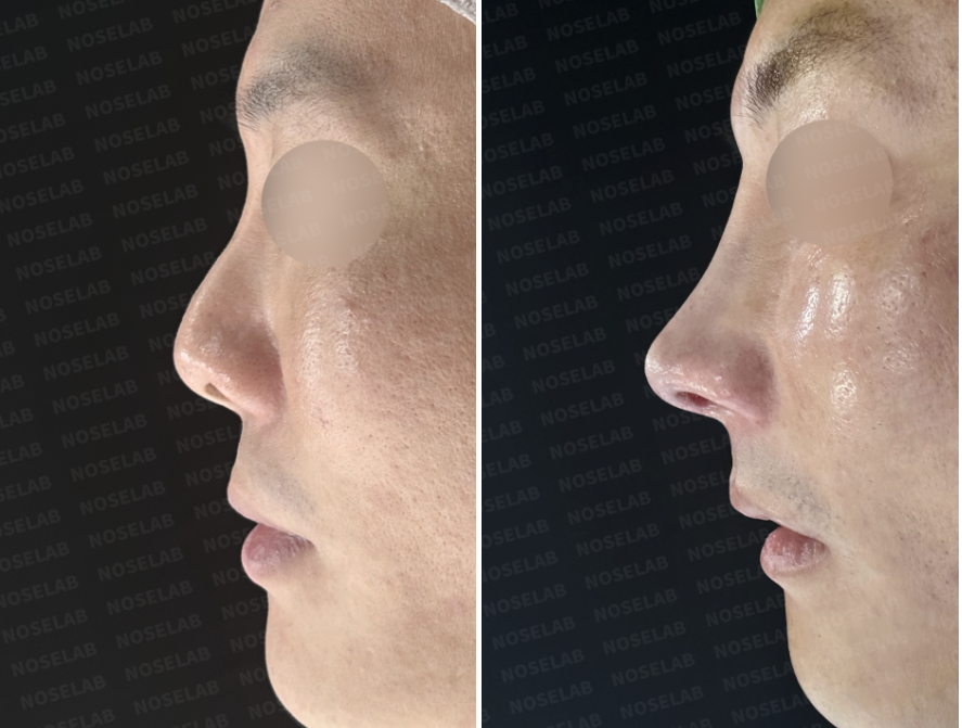 Before and immediately after side profile comparison following closed rhinoplasty Korea, showing correction of an upturned nasal tip, refined bridge-to-tip curve, improved nasolabial angle, and stabilized nasal structure after contracted nose revision using autologous rib cartilage.