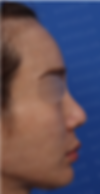 Preoperative side profile showing deviated nasal tip and long philtrum before crooked nose and asymmetric nostrils correction