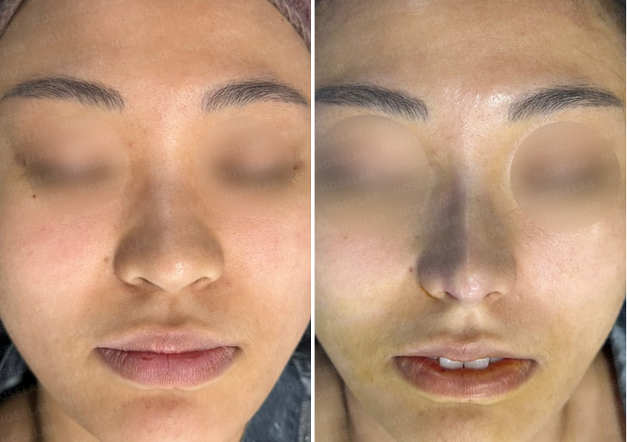 Frontal view comparison showing the patient before surgery (left) and immediately after straight-line rhinoplasty with nasal tip refinement (right).