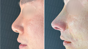 Side view before and after closed rhinoplasty using autologous rib cartilage – correction of nasal deviation and tip support