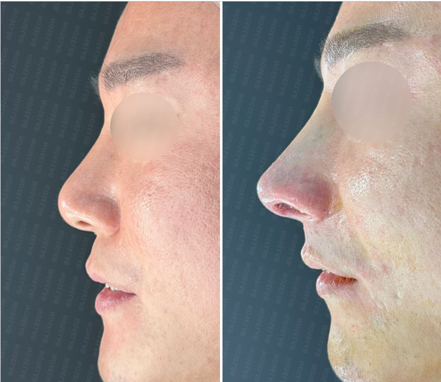 Side view before and immediately after surgery – correction of deviated nose and nasal tip refinement