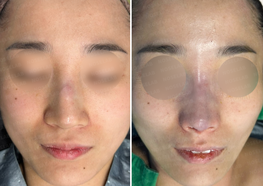 Frontal comparison of nasal inflammation revision case: Before surgery (left) showing implant protrusion and skin redness, and immediately after closed nasal inflammation revision surgery (right).
