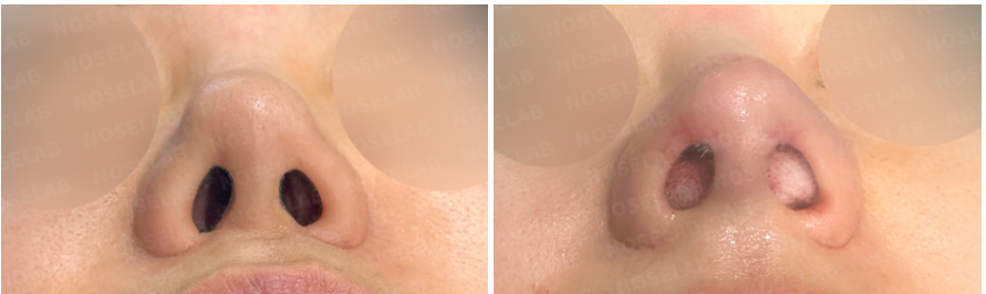 Nostril view comparison before and immediately after secondary rhinoplasty, showing improved nostril symmetry and refined alar base contour.