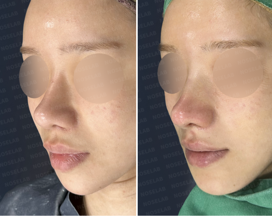 Before and after oblique view of revision rhinoplasty for deviated nose Korea