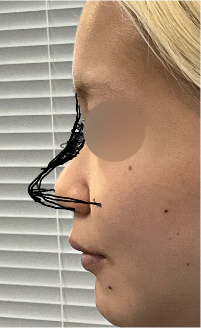 Side profile preoperative design photo showing droopy nasal tip, retracted columella, flat nasion, and excessively protruding maxilla