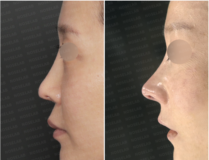 Side before and immediately after views showing improved nasal bridge line and nasal tip support after rib cartilage reconstruction.