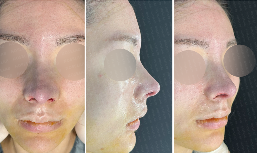Immediate post-surgery photos: frontal view, 45-degree oblique view, and side profile after rhinoplasty, showing improved nasal tip and bridge