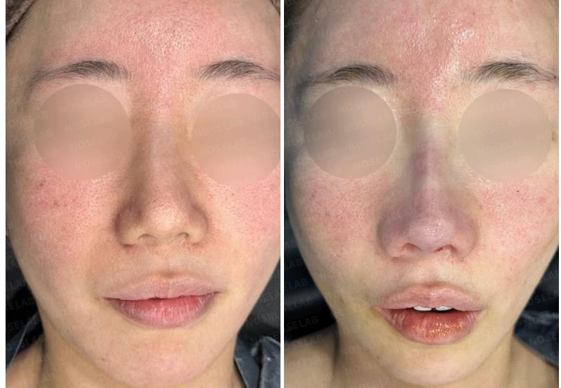 Frontal comparison before surgery and immediately after autologous rib cartilage reconstruction – collapsed columella and bulbous nasal tip corrected