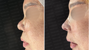 Side before and immediately after views showing columella retraction correction and bridge line reconstruction.