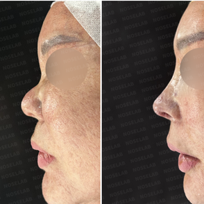 Side before and immediately after views showing columella retraction correction and bridge line reconstruction.