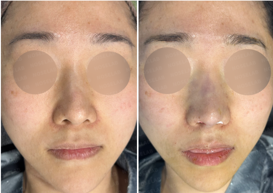 Frontal view comparison before and immediately after implant-free nasal reconstruction using autologous rib cartilage.