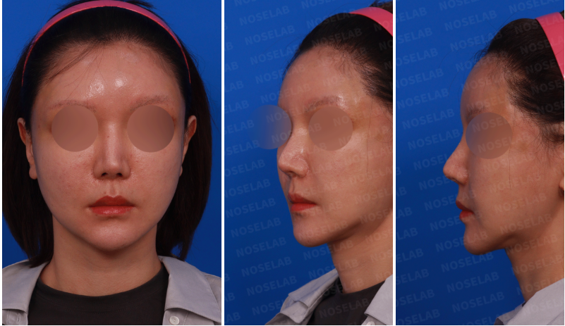 Preoperative design consultation photos for autologous rib cartilage reconstruction – frontal, left oblique side, and left side views of female patient