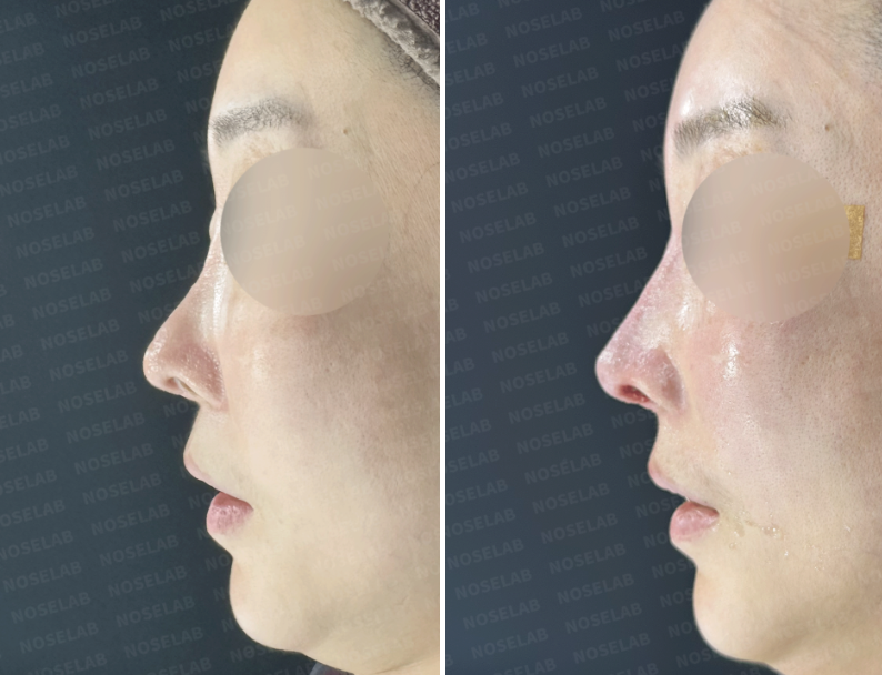 Before and after complex revision rhinoplasty – side view comparison of female patient