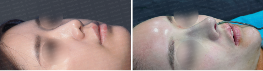 Protruding mouth rhinoplasty – before and after 45-degree oblique view comparison photos (left: before surgery, right: after surgery)