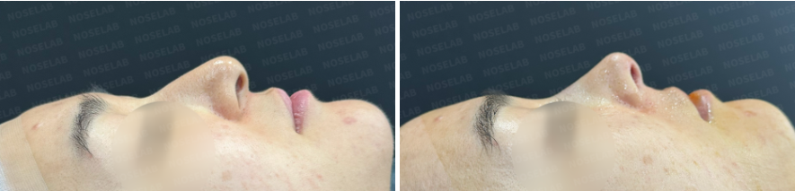Side profile view before surgery (left) after surgery (right)