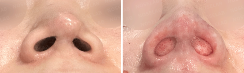 Before and immediately after closed rhinoplasty in Korea – Nostril view