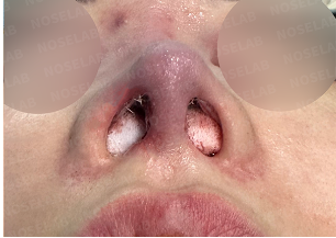 Immediate postoperative nostril view after long nose correction, showing improved symmetry and smoother columella.