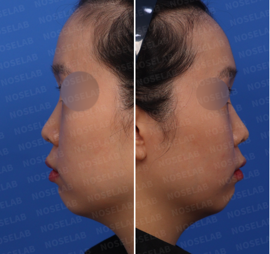 Short nose rhinoplasty – pre-surgery design consultation side view photo