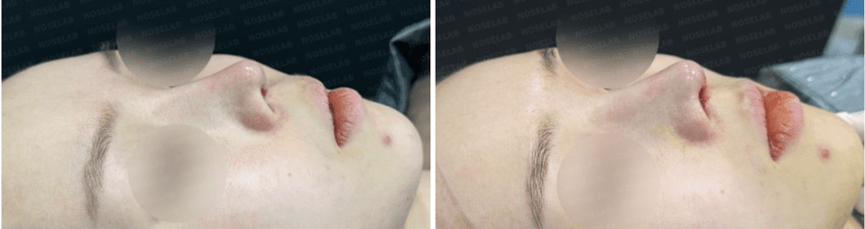 Photos were taken immediately before and after the surgery with the consent of the patient.