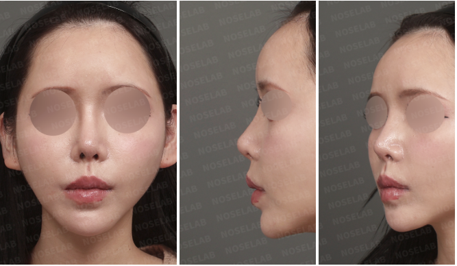 Preoperative frontal, left side, and left oblique views before upturned nasal tip correction rhinoplasty.