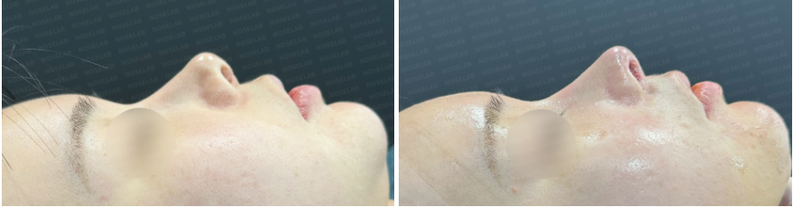 Before and after comparison – side view of a patient before surgery (left) and immediate results after Revision Rhinoplasty Korea with closed approach (right), showing corrected upturned tip, improved nasolabial angle, and natural nasal contour.