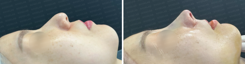 Side profile before surgery (left), After surgery (right)