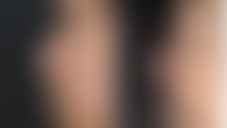 Before and immediately after left lateral view demonstrating dorsal hump reduction, straighter nasal bridge line, and improved tip support following closed rhinoplasty korea for crooked hump nose.