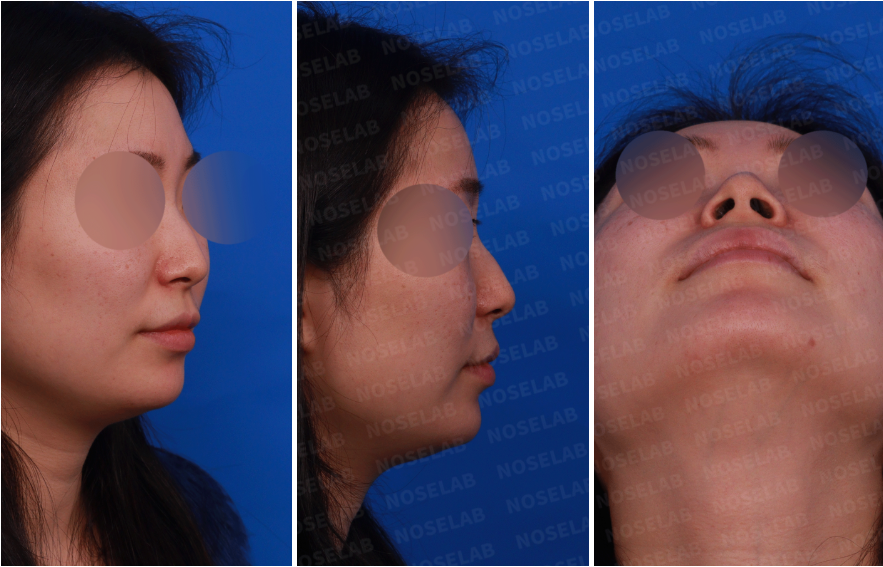 Right oblique side view, right side view, and nostril view photos before hump nose and deviated nose correction – Nose Lab Clinic