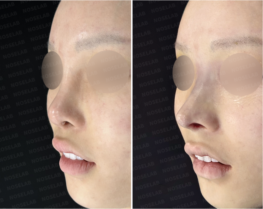 Before and immediately after surgery oblique view showing improved nasal bridge alignment and lowered radix with a natural dorsal contour following revision closed rhinoplasty with rib cartilage reconstruction.