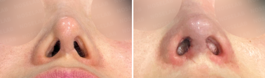 Nostril base view before and after contracted nose reconstruction, showing correction of asymmetrical nostrils and improved columella alignment with autologous rib cartilage.