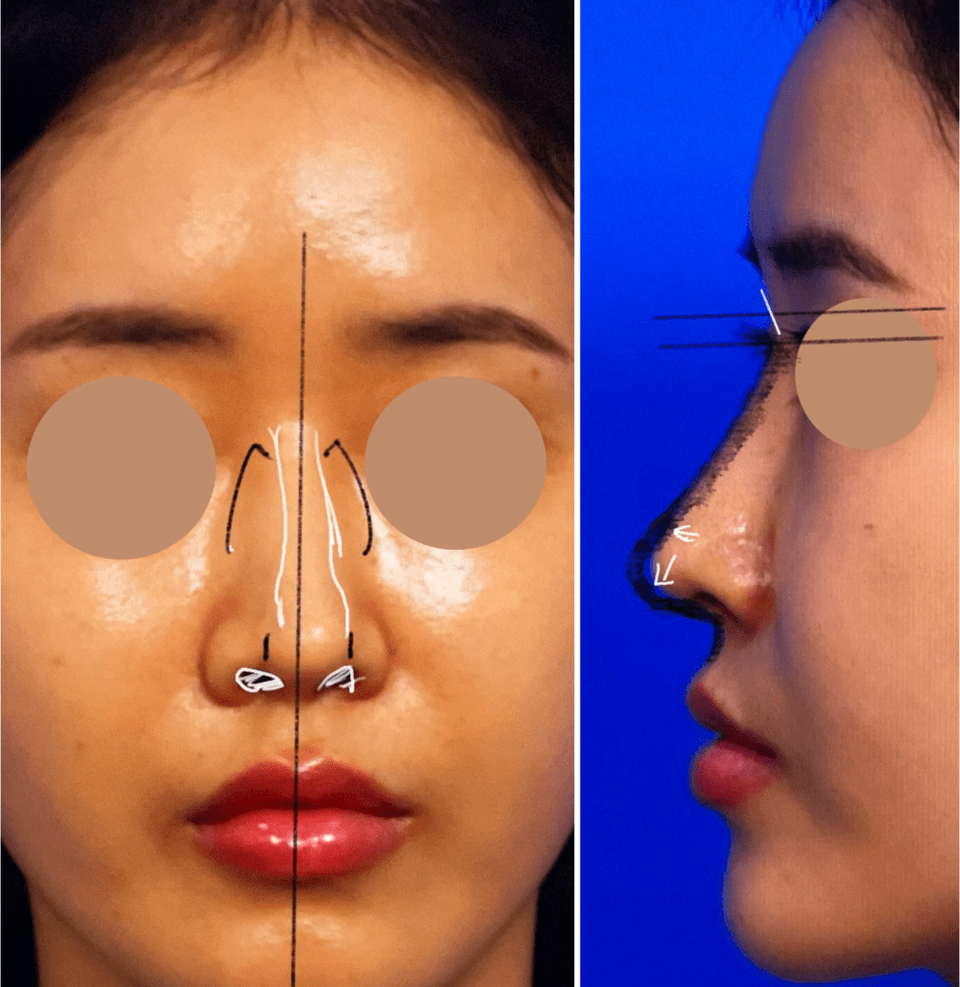 Frontal and side view photos before nasal mucosal adhesion correction showing nasal deviation to the right, wide nasal tip, and high glabella starting point during preoperative consultation.