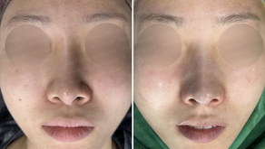 Before and immediately after surgery frontal view showing correction of deviated nasal axis, elevation of drooping nasal tip, improved symmetry, and enhanced overall facial balance following revision closed rhinoplasty with rib cartilage reconstruction.